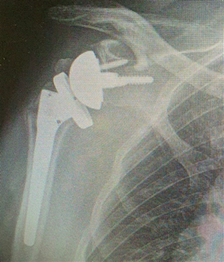 Golfing Injuries - Humerus - Shattered Shoulder X-ray v1
